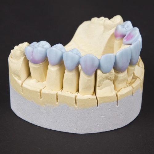 Wax up model of a row of lower teeth