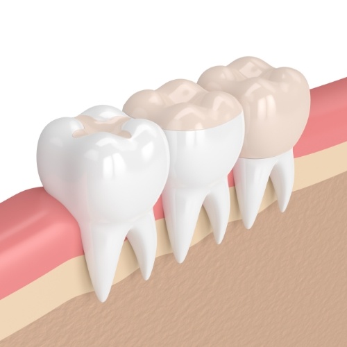 Three animated teeth that have been repaired with various sizes of dental inlays and onlays