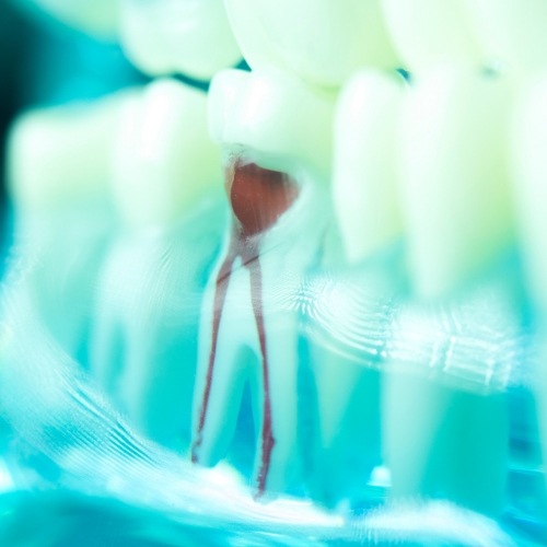 Model of a tooth showing the shape of the root canals inside of it