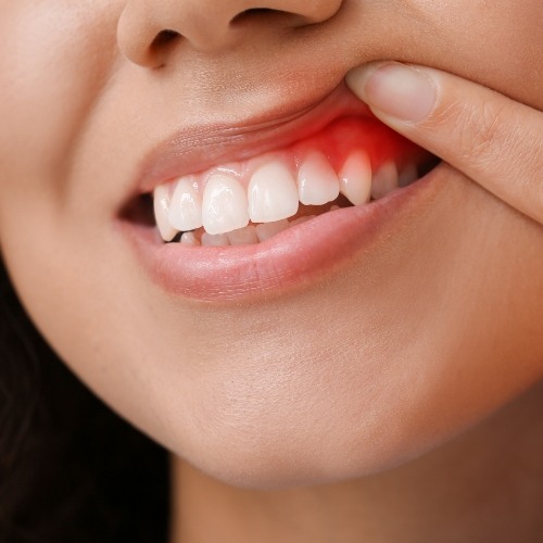 Close up of a woman with red gums