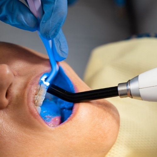 Dentist giving a child patient dental sealants in Norman