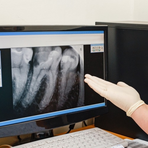 Gloved hand gesturing toward a computer screen showing digital dental x rays of a few teeth