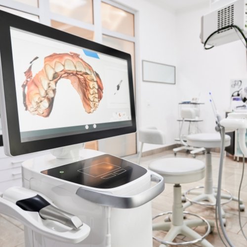 Computer screen showing digital dental impressions of a patient's teeth