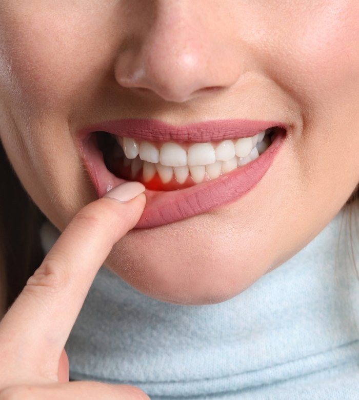 Close up of person pointing to their red gums