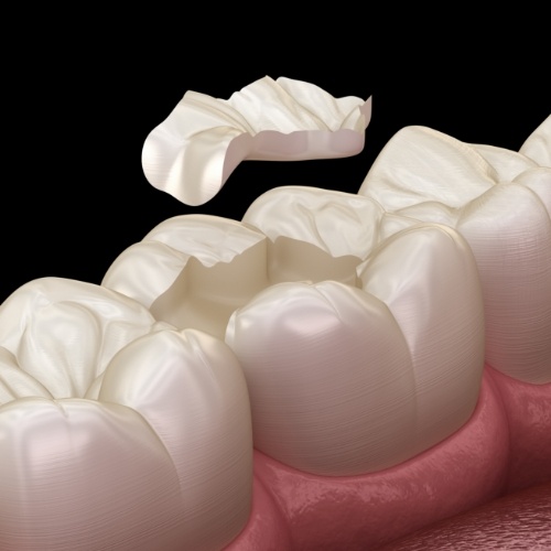 Animated dental inlay being placed over a tooth