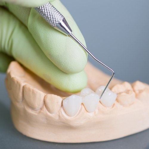 Dentist crafting a dental bridge to replace a missing tooth