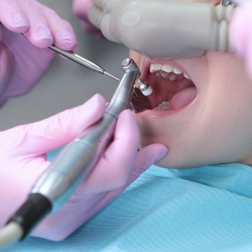 Close up of a dental patient receiving treatment