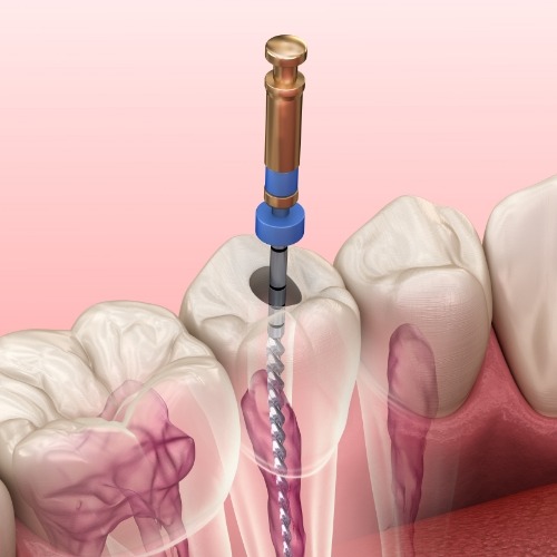Animated dental tool entering a tooth to perform root canal treatment in Norman
