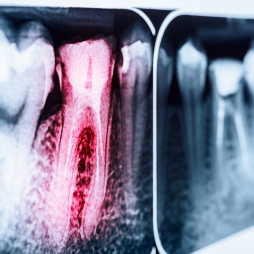 Dental X ray showing a tooth that needs root canal treatment