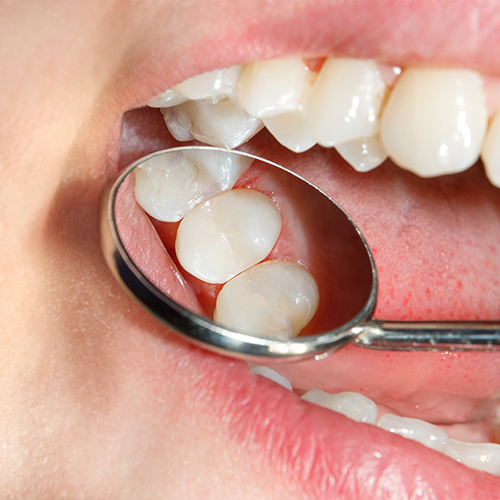 Dental mirror showing a patient's mouth with a tooth colored filling in Norman