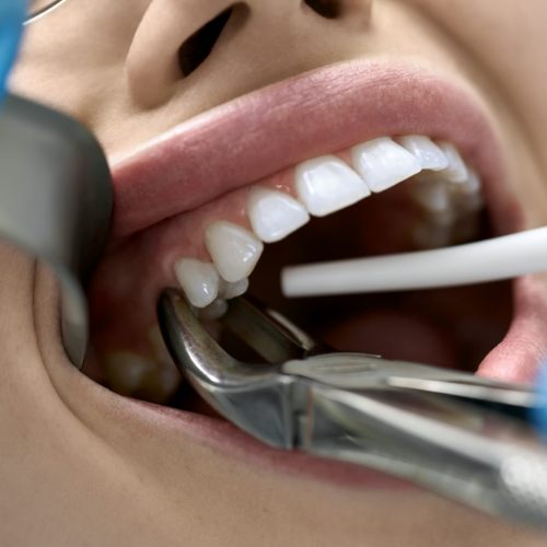 Close up of a patient's mouth right before a tooth extraction