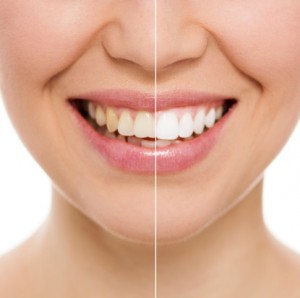 teeth whitening you can trust
