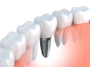 Find modern tooth replacement options with Norman dentist, Dr. Bobby Carmen. Are bridgework or dental implants right for you?