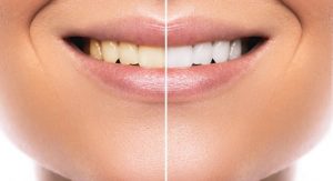 Before and after teeth whitening