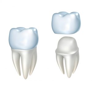 Image of dental crown