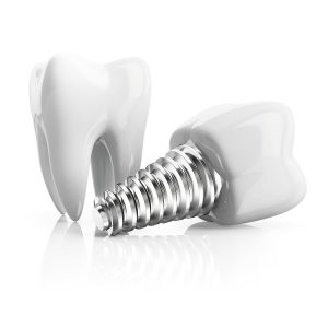 dental implant and molar