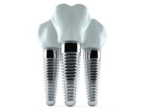 Image of 3 dental implants