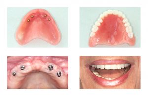 Before and after of dental implants