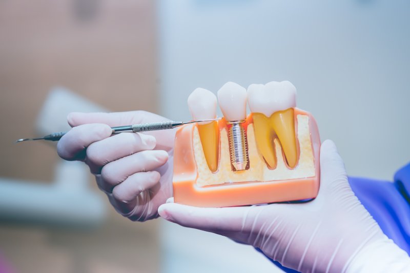 Dentist pointing to a model of a dental implant.