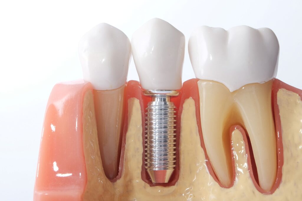 Model titanium dental implant in sample jaw
