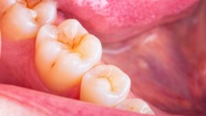 teeth plagued by cavities